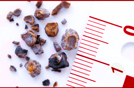 Difficult Renal Stones UrologyStone