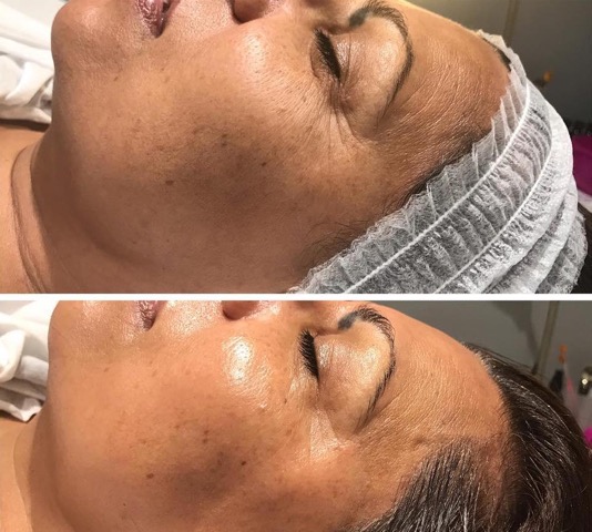 Dermaplaning UrSkin Clinic