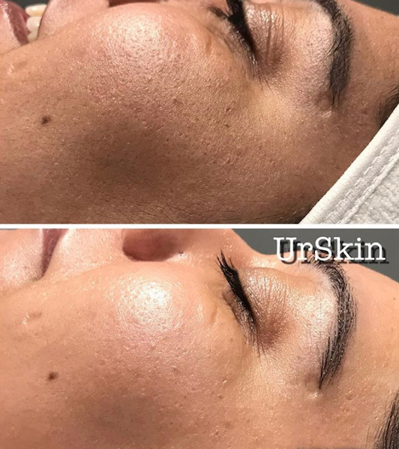 Dermaplaning UrSkin Clinic