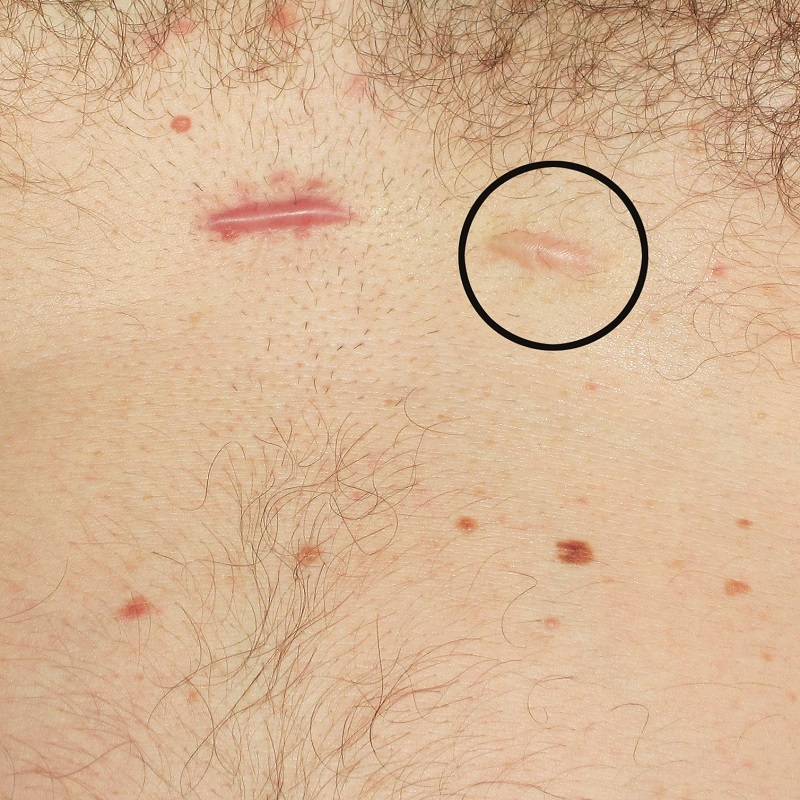 Strataderm for the professional scar therapy gel for old and new scars