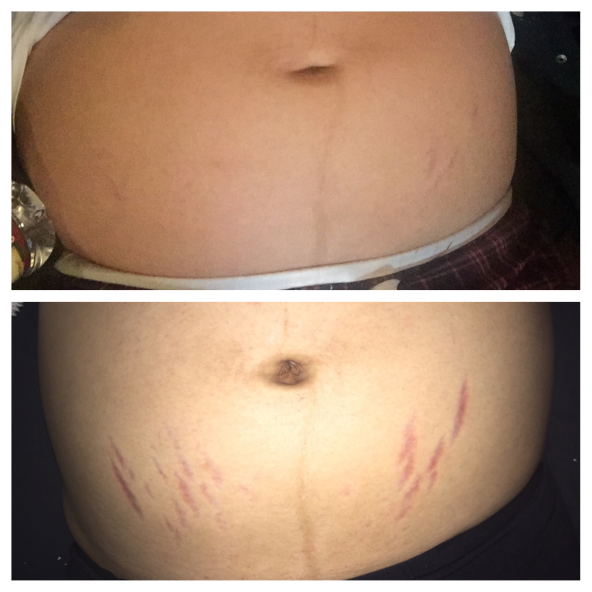 The stretch marks have arrived — The Bump