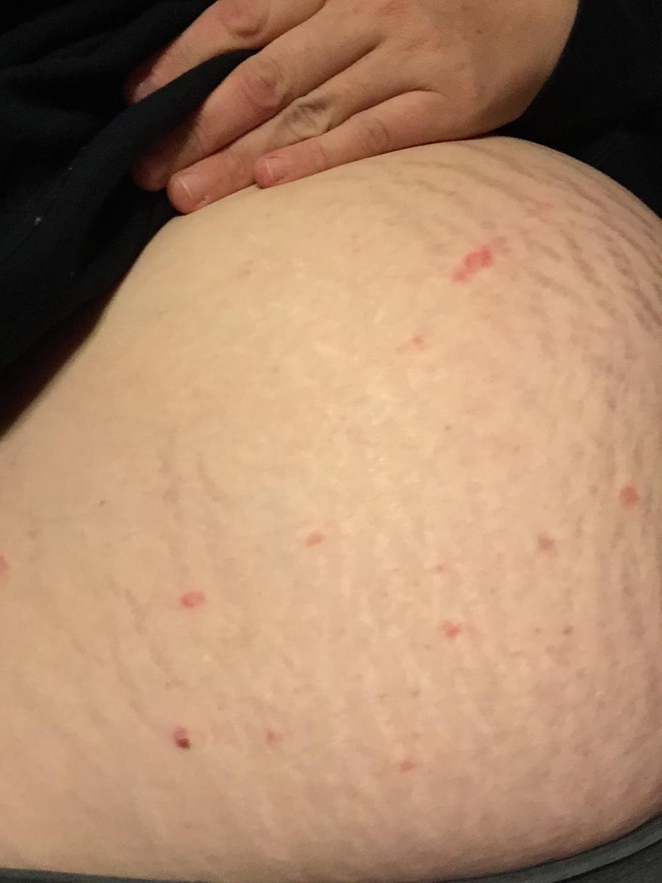 Diagnosing PUPPP — The Bump