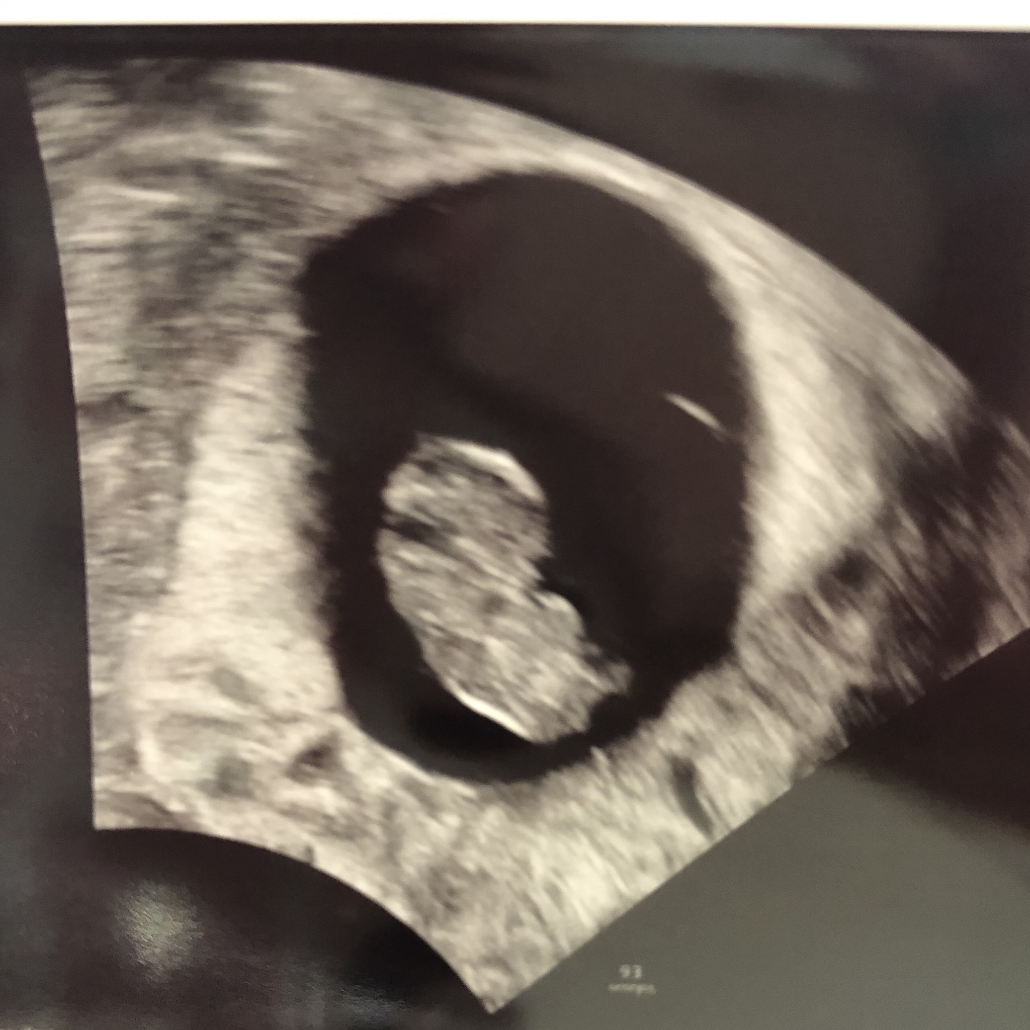 The Ultrasound Thread Page 4 — The Bump
