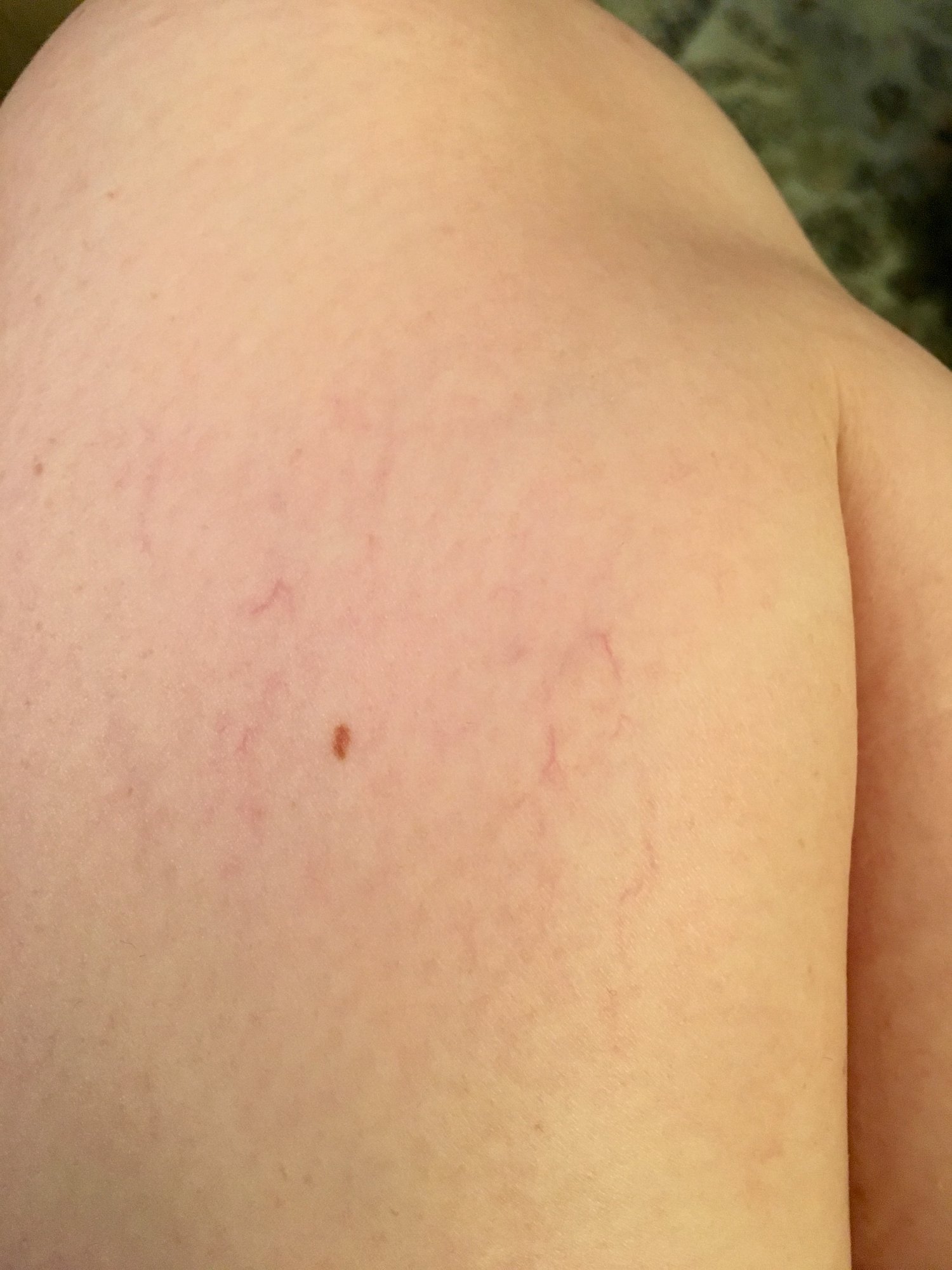 Stretch marks on legs — The Bump