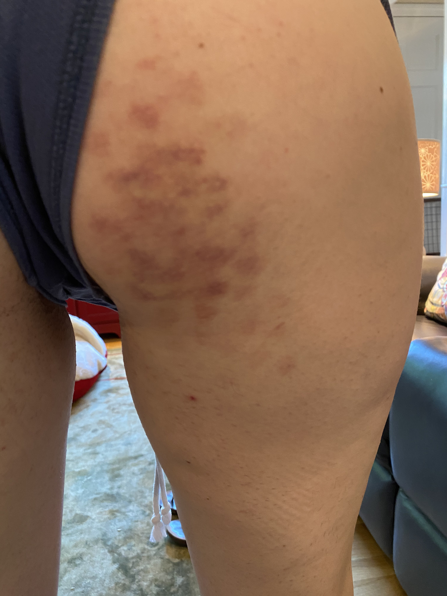 Rash on butt cheek — The Bump