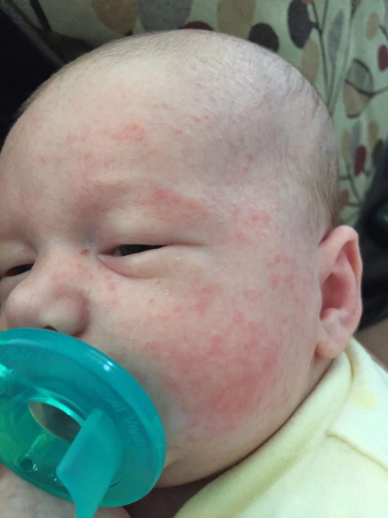 Mystery rash? — The Bump