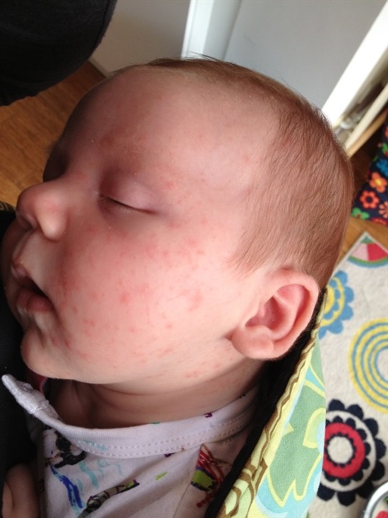 Dairy allergy, heat rash or acne? — MadeForMums Forum