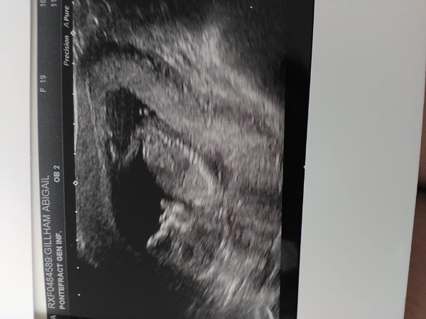How to tell if girl or boy from your scan pictures? Page 4