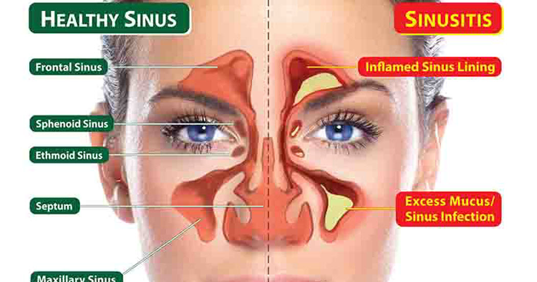 Take One Spoonful Of This Homemade Remedy And Your Painful Stuffy