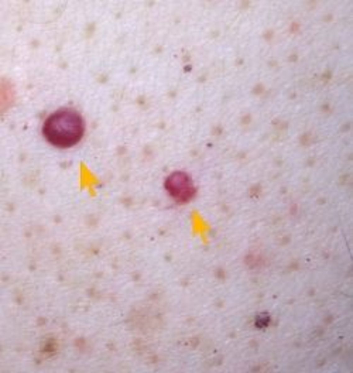 Collection 101+ Images Cherry Angioma On Scalp Pictures Superb 10/2023