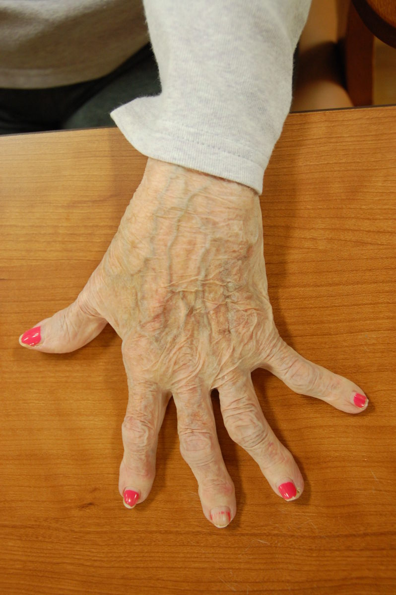 Relieve Arthritis Pain and Stiffness in the Hands With Contrast Baths