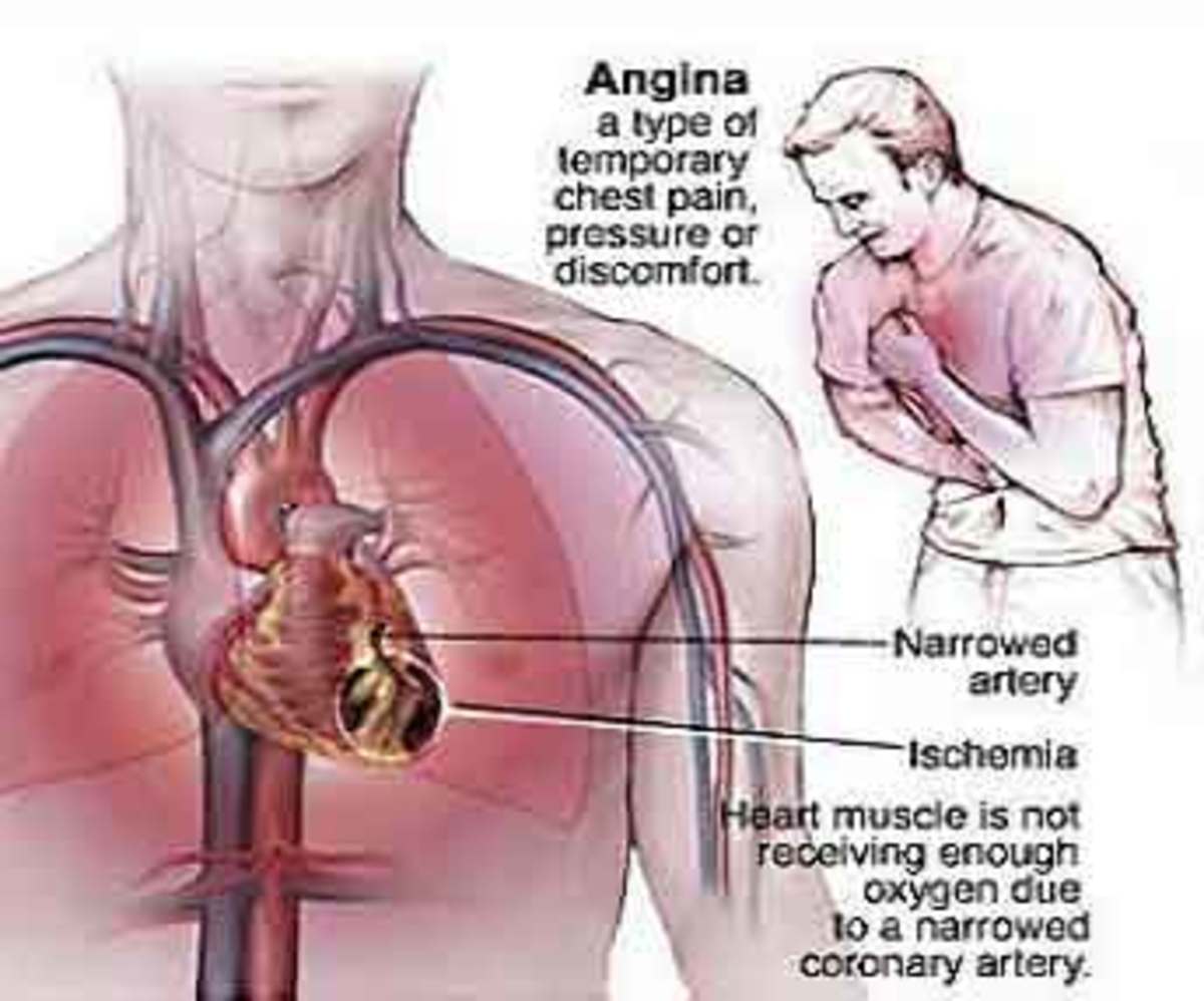 Blocked Artery Symptoms & Silent Heart Attacks hubpages