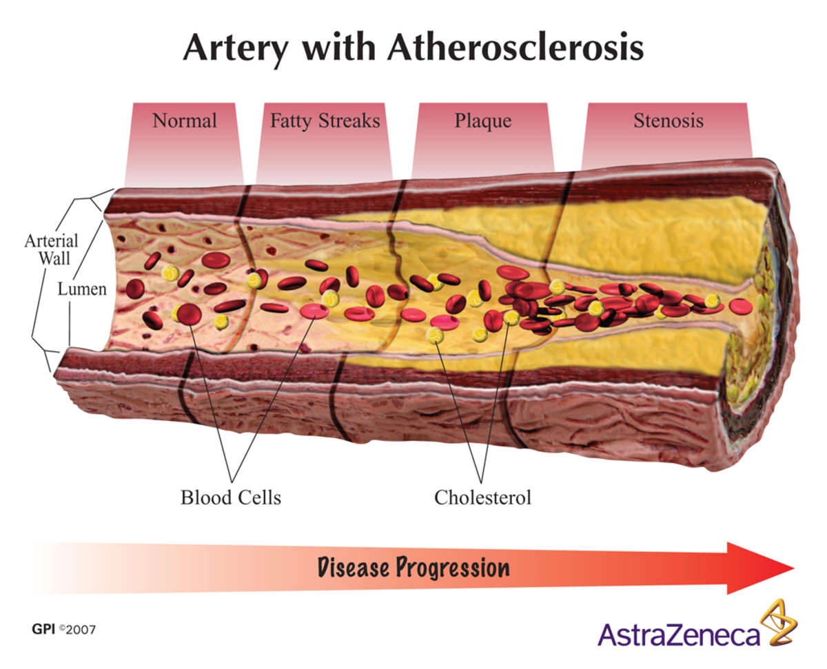 Blocked Artery Symptoms & Silent Heart Attacks hubpages