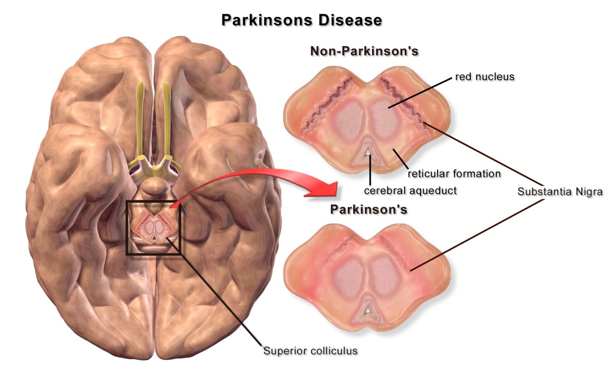Parkinson's Disease Facts and the Hope of Stem Cell Treatment Owlcation