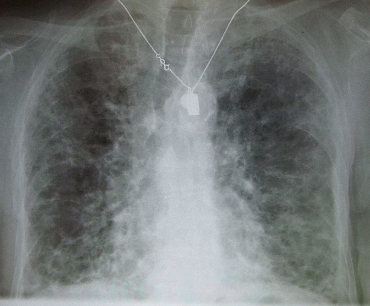 Dark Lung Spots on XRay hubpages