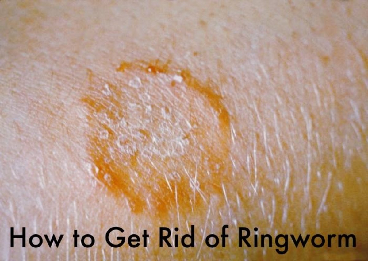 How to Get Rid of Ringworm HealDove
