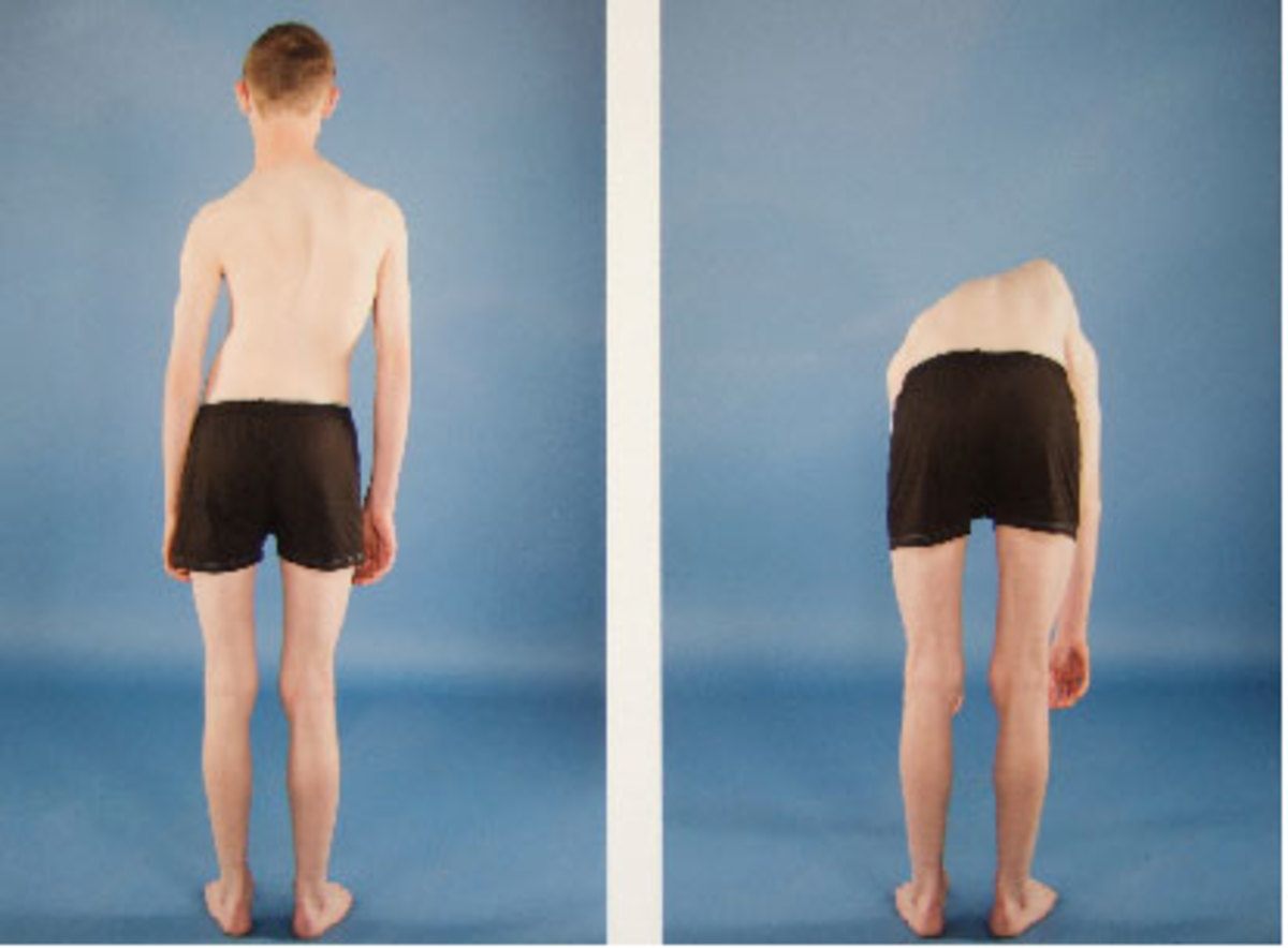 Scoliosis and Dancers HubPages