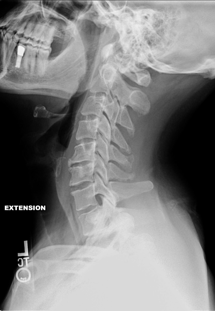 Bone Spur Facts, Effects, and Possible Treatments