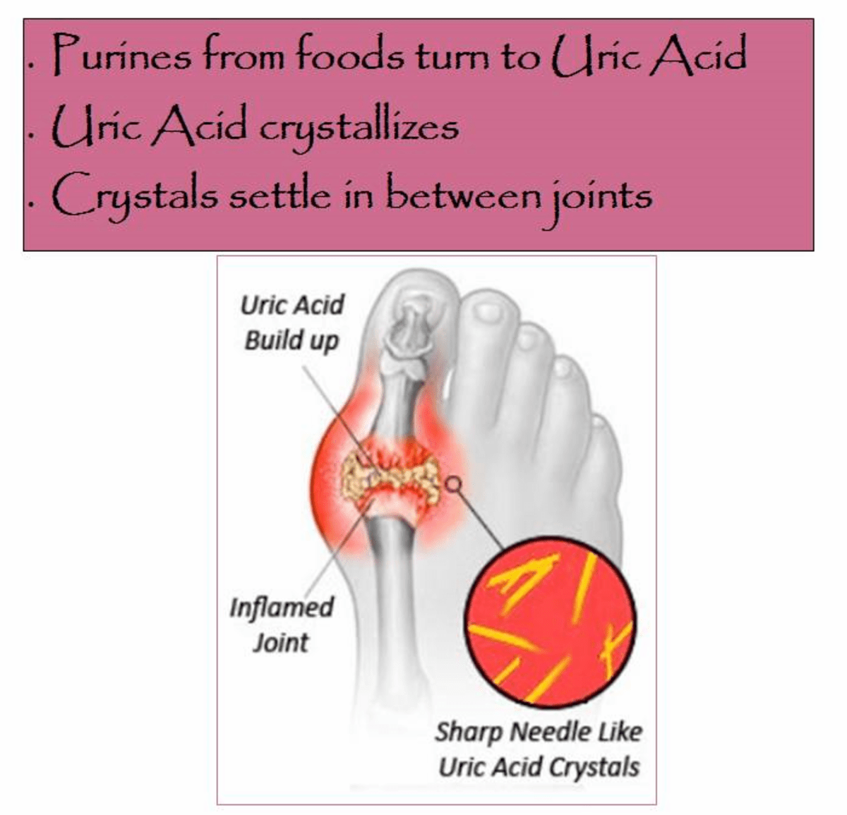 Everything You Ever Wanted to Know About Gout Causes, Symptoms