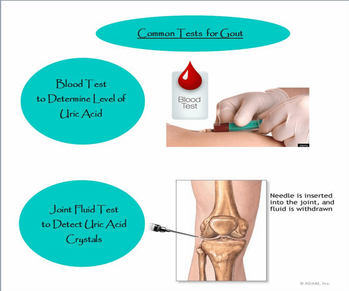 Everything You Ever Wanted to Know About Gout Causes, Symptoms