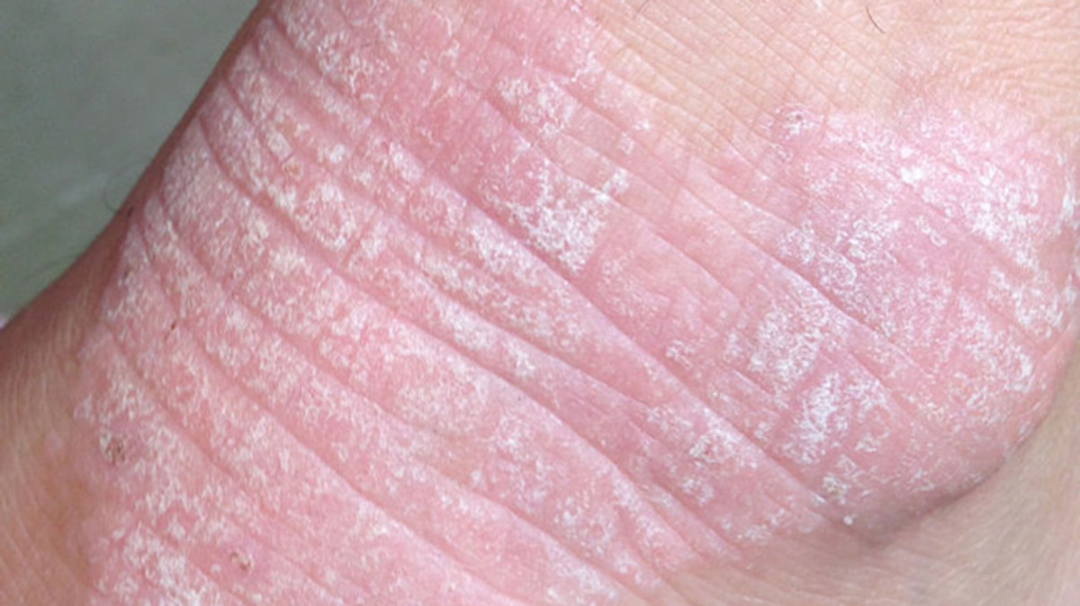 Living With Celiac Disease HealDove