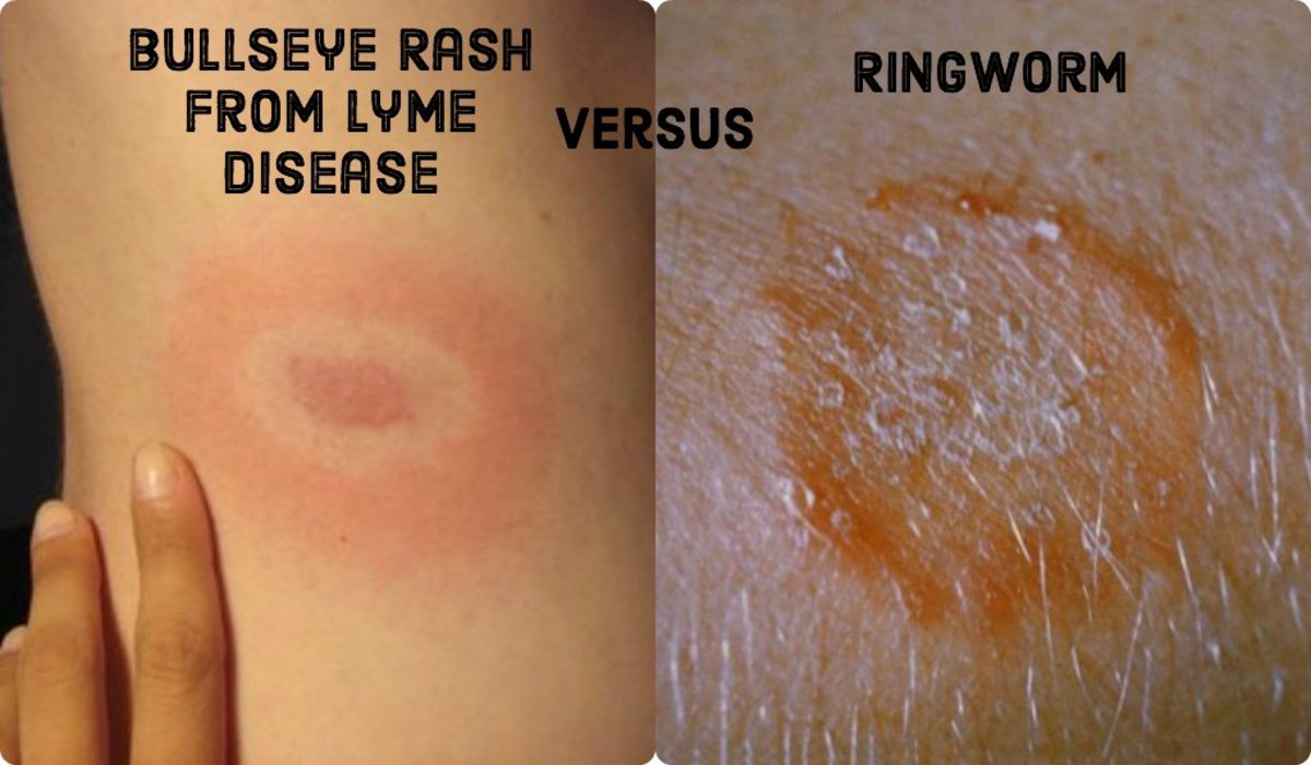 Bullseye Rashes Ringworm and Lyme Disease Differences HealDove