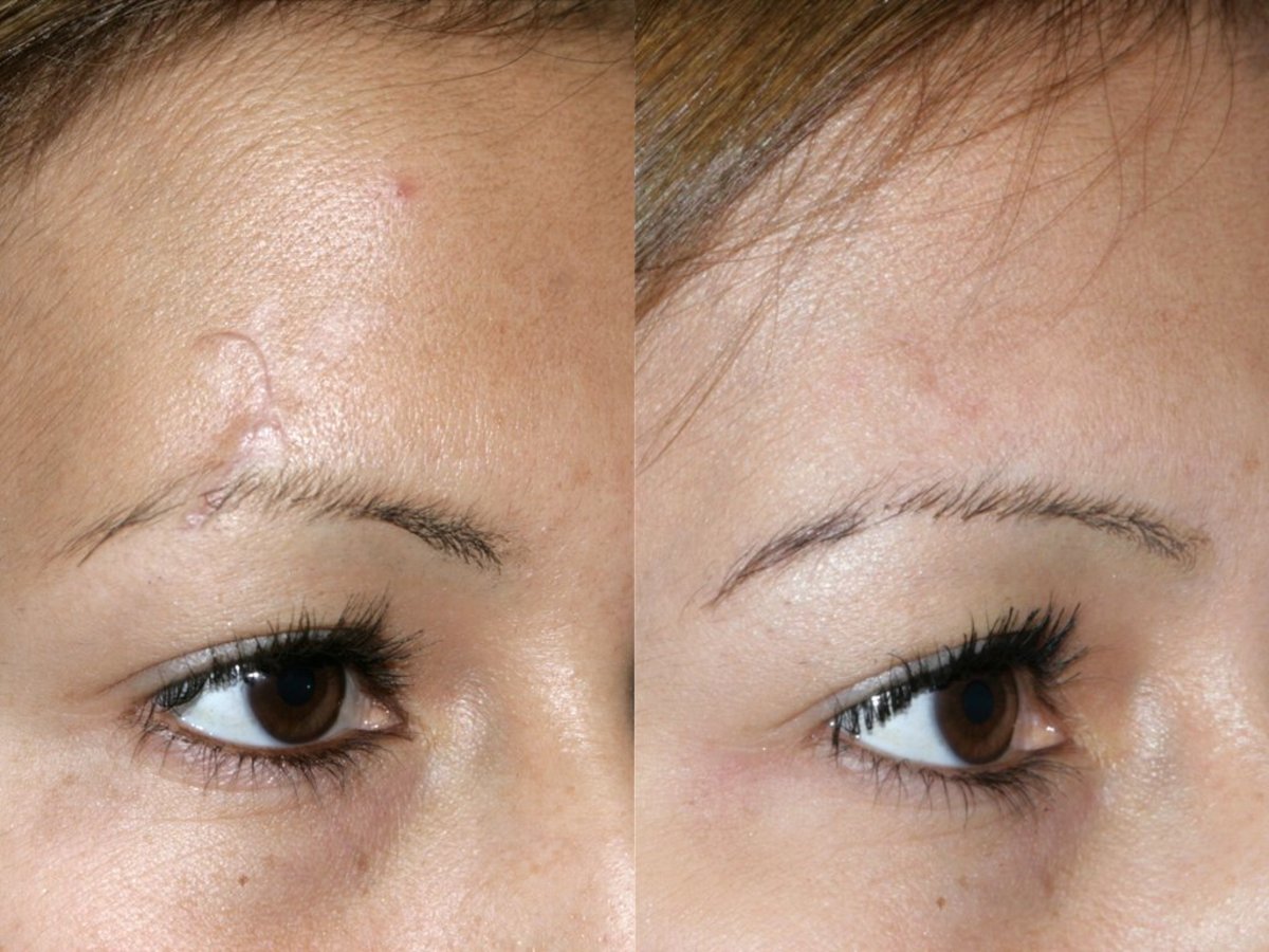 Reduce Stretchmarks, Keloids, or Scars With Essential Oils Bellatory