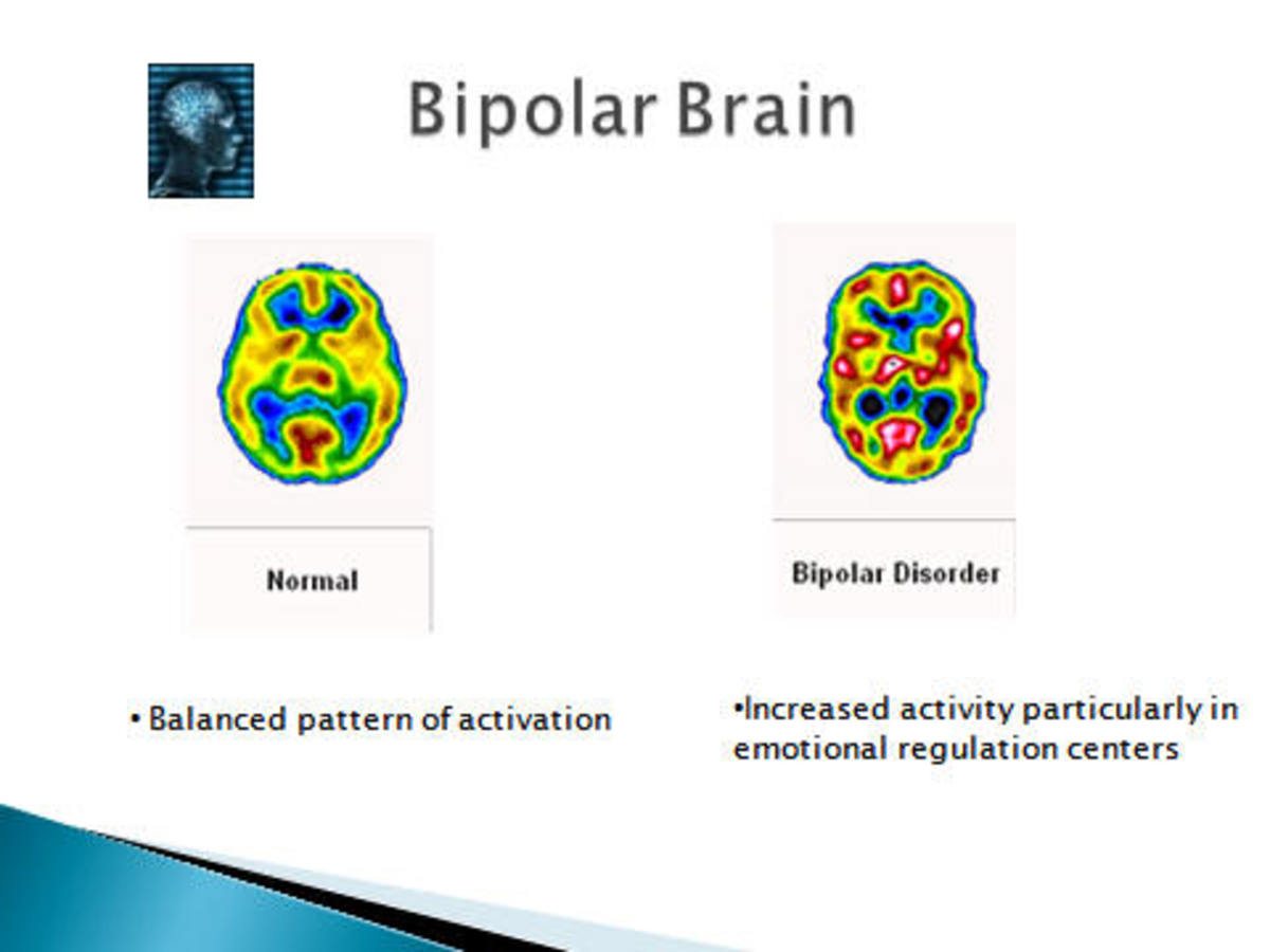 What Are The Different Types Of Bipolar Disorder hubpages