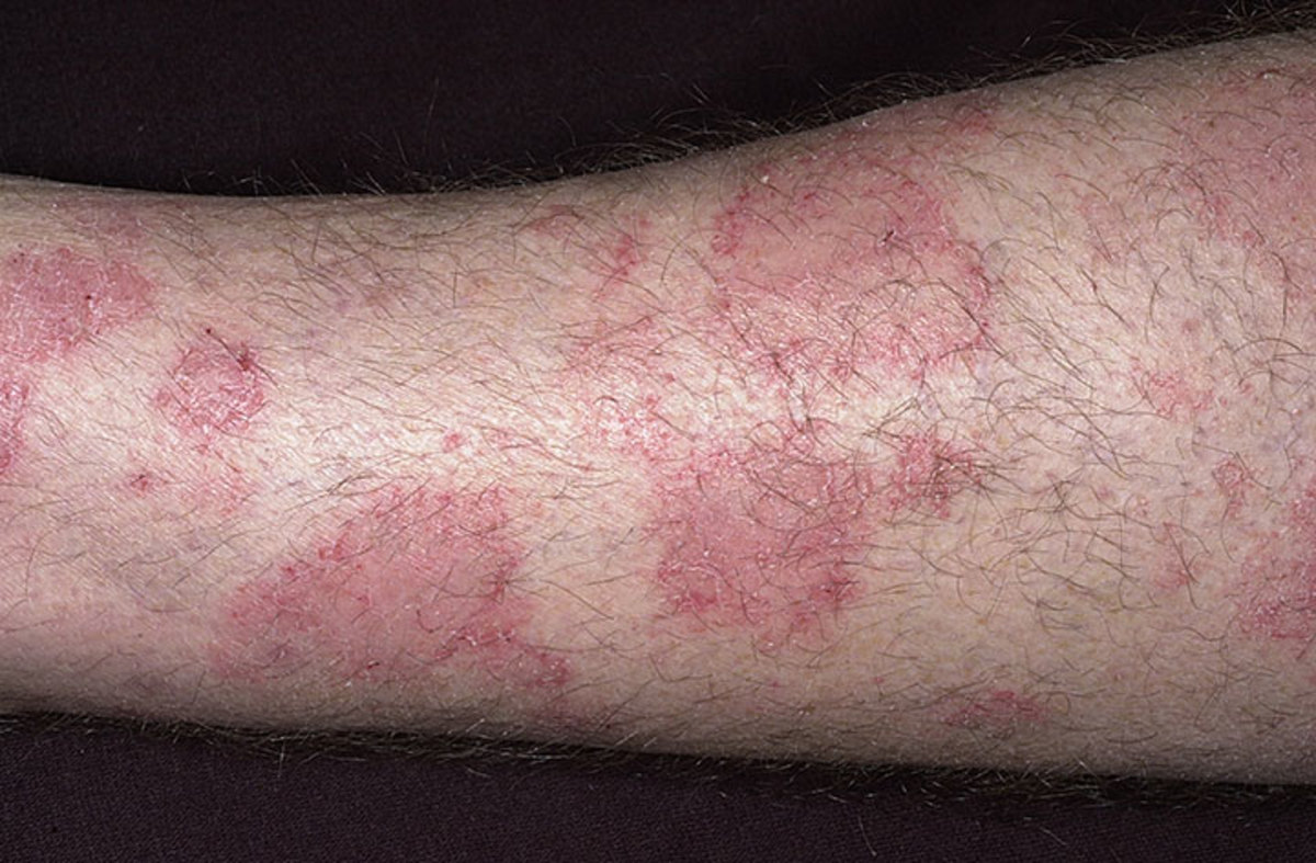 Pretibial Myxedema Pictures, Treatment, Symptoms, Causes hubpages