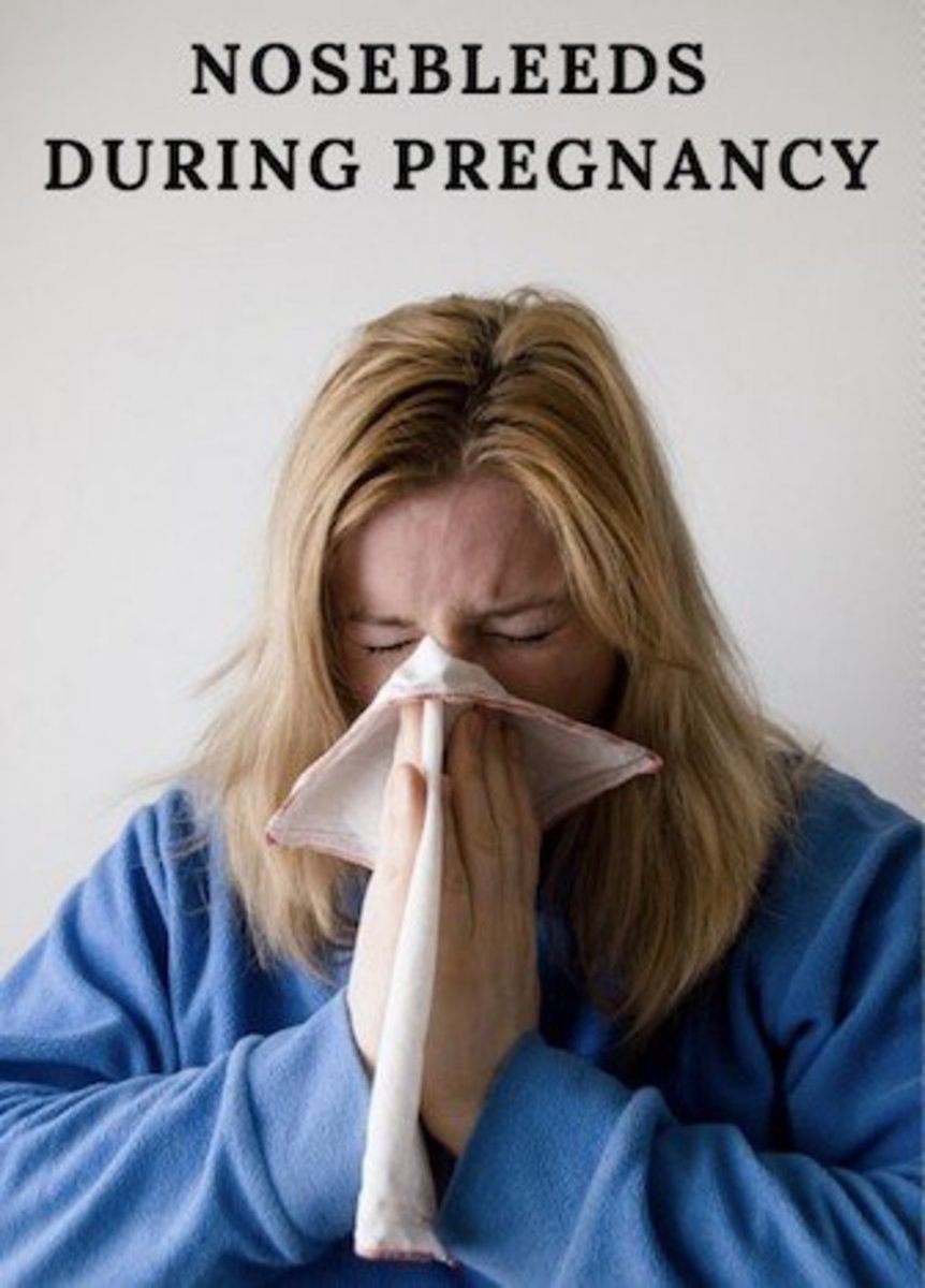 Nosebleeds During Pregnancy When You Should Be Concerned WeHaveKids