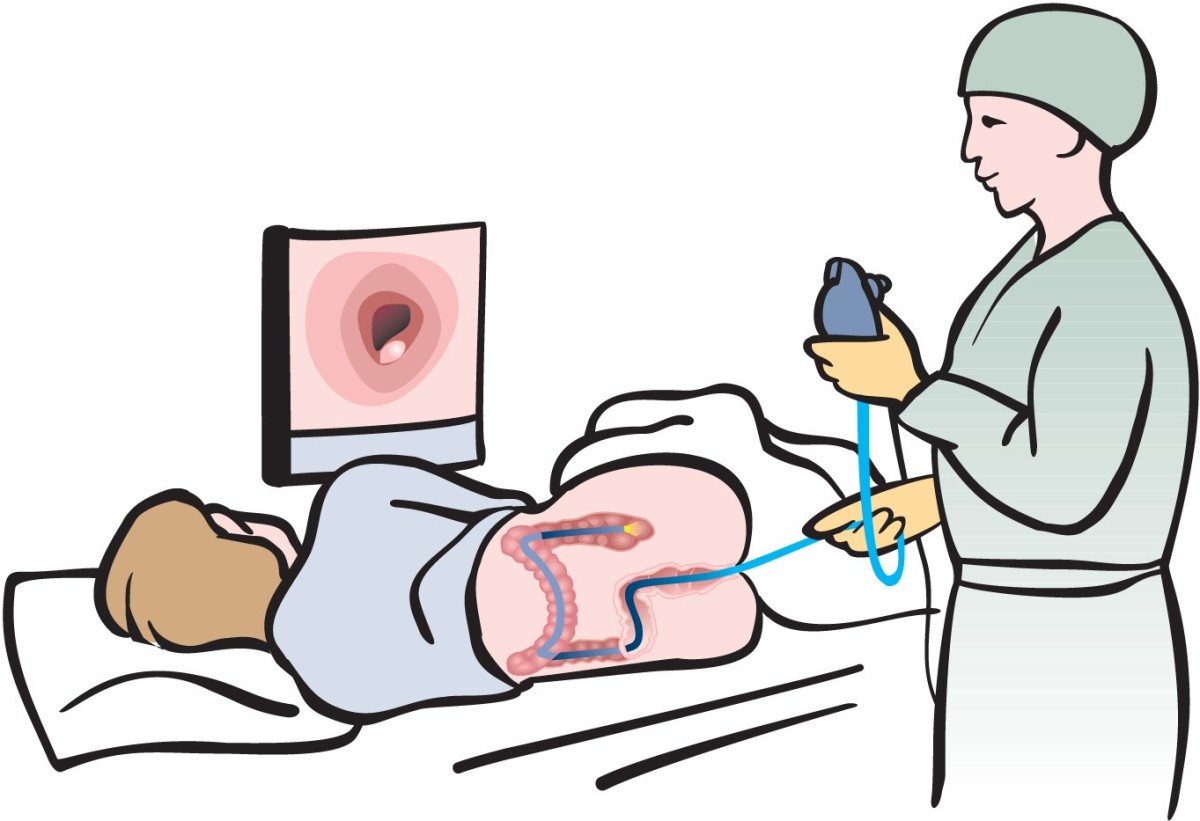 Colon Cancer is Preventable with a Colonoscopy HubPages