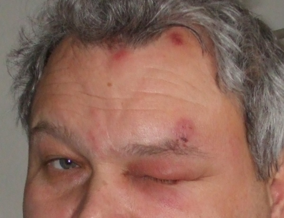 Do I Have Shingles? Symptoms, Causes and Natural Remedies for Shingles