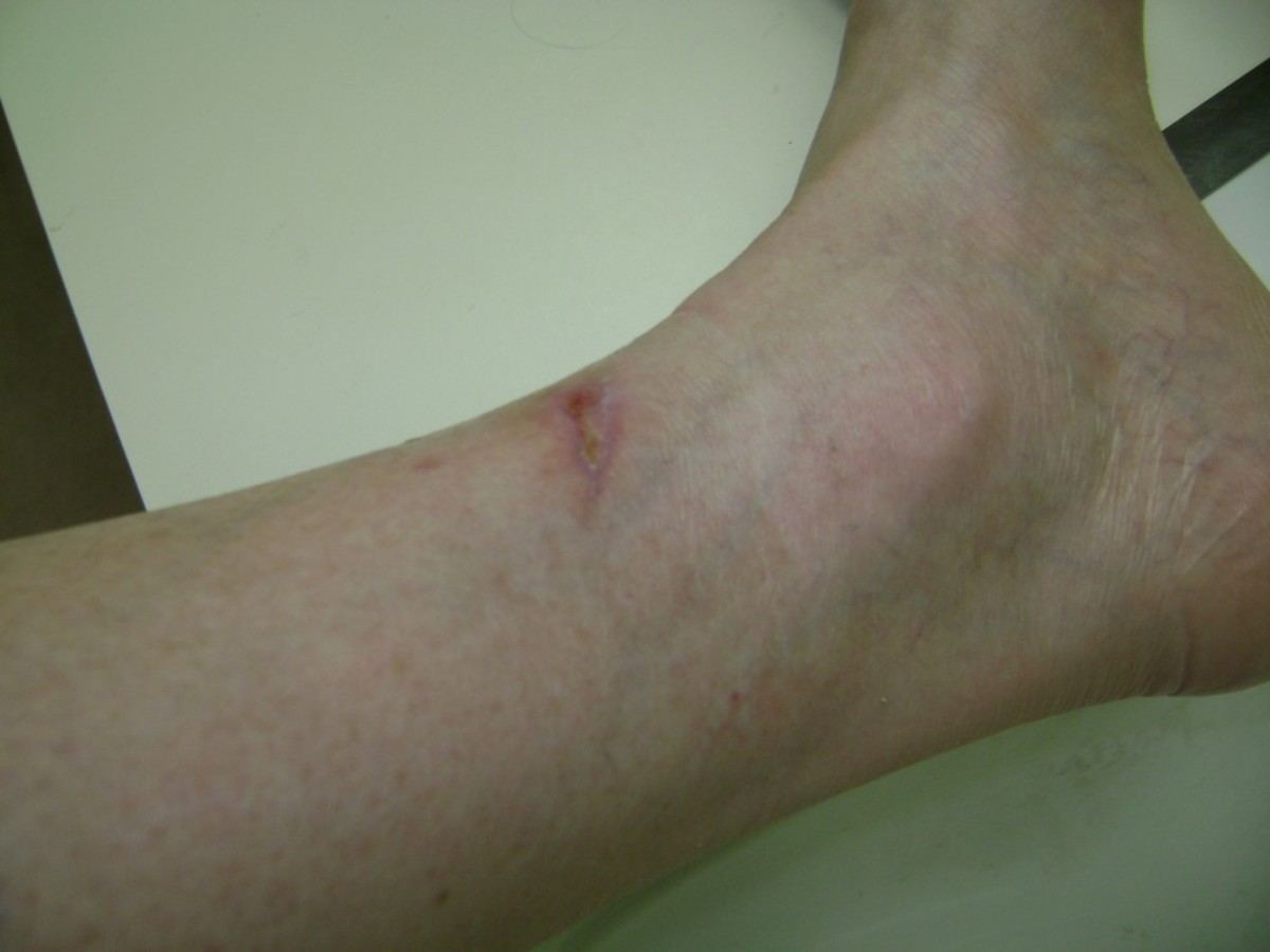 What Is a Pseudomonas Aeruginosa Infection Like? HealDove