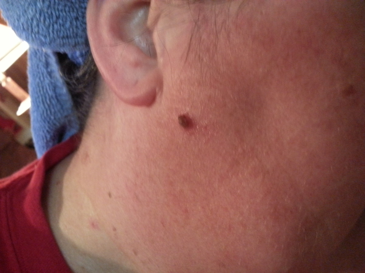 Oregano and Frankincense for Warts My Results, with Pictures RemedyGrove