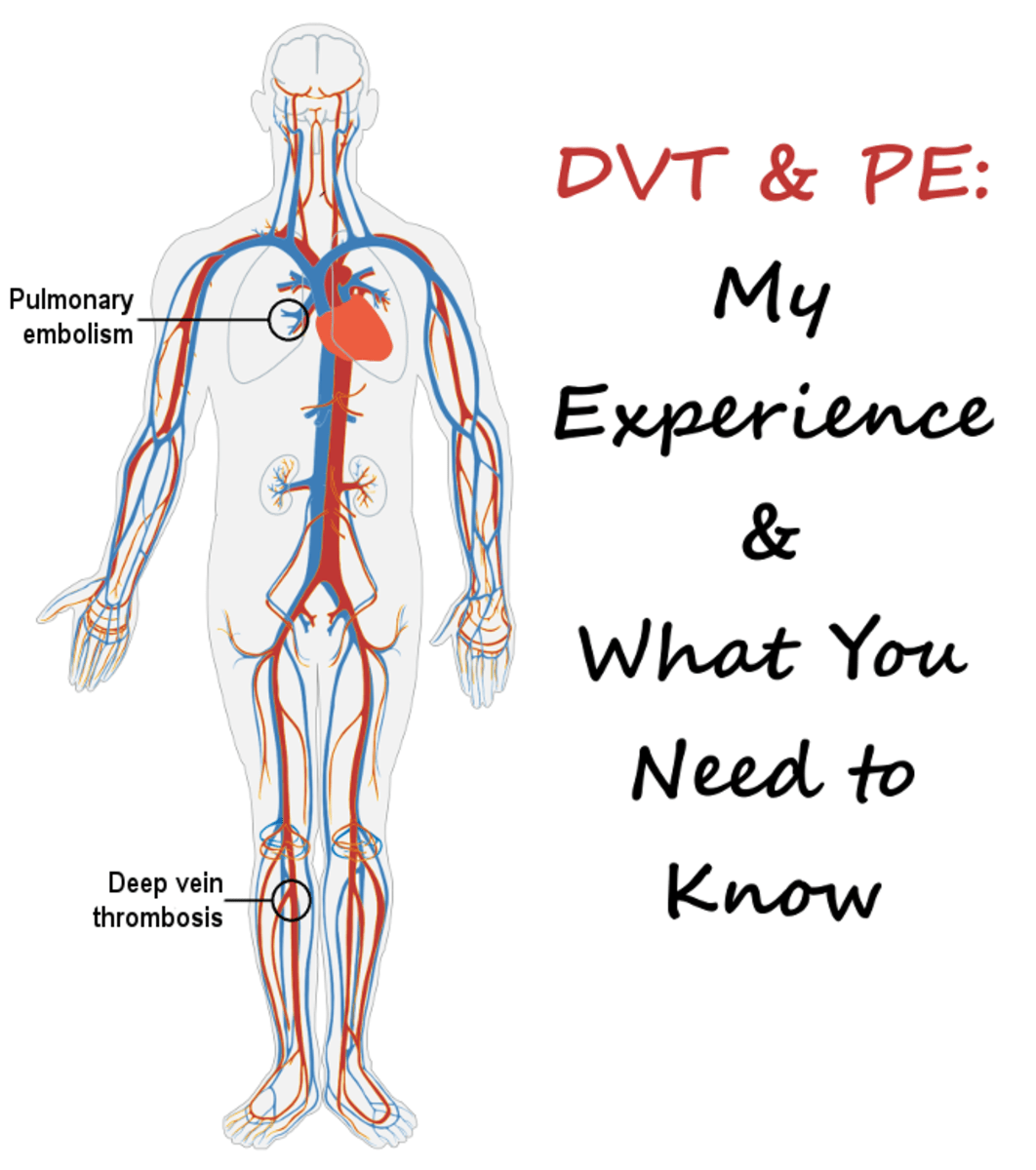 DVT and PE Causes, Symptoms, Treatment, and Prophylaxis Patient's Lounge