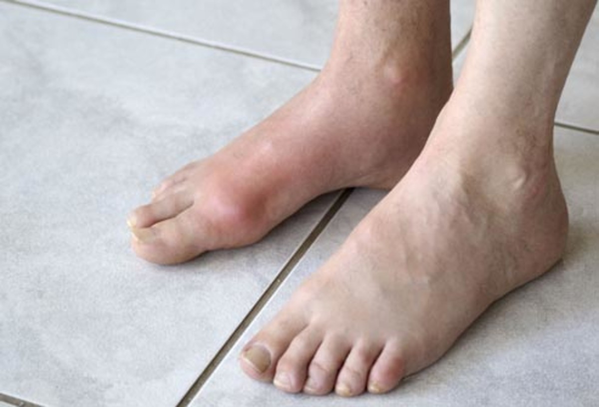 How Diabetes Affects Your Feet and Diabetic Foot Care HubPages