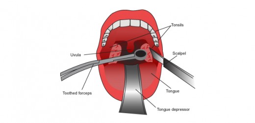 Adult Tonsillectomy Recovery HubPages