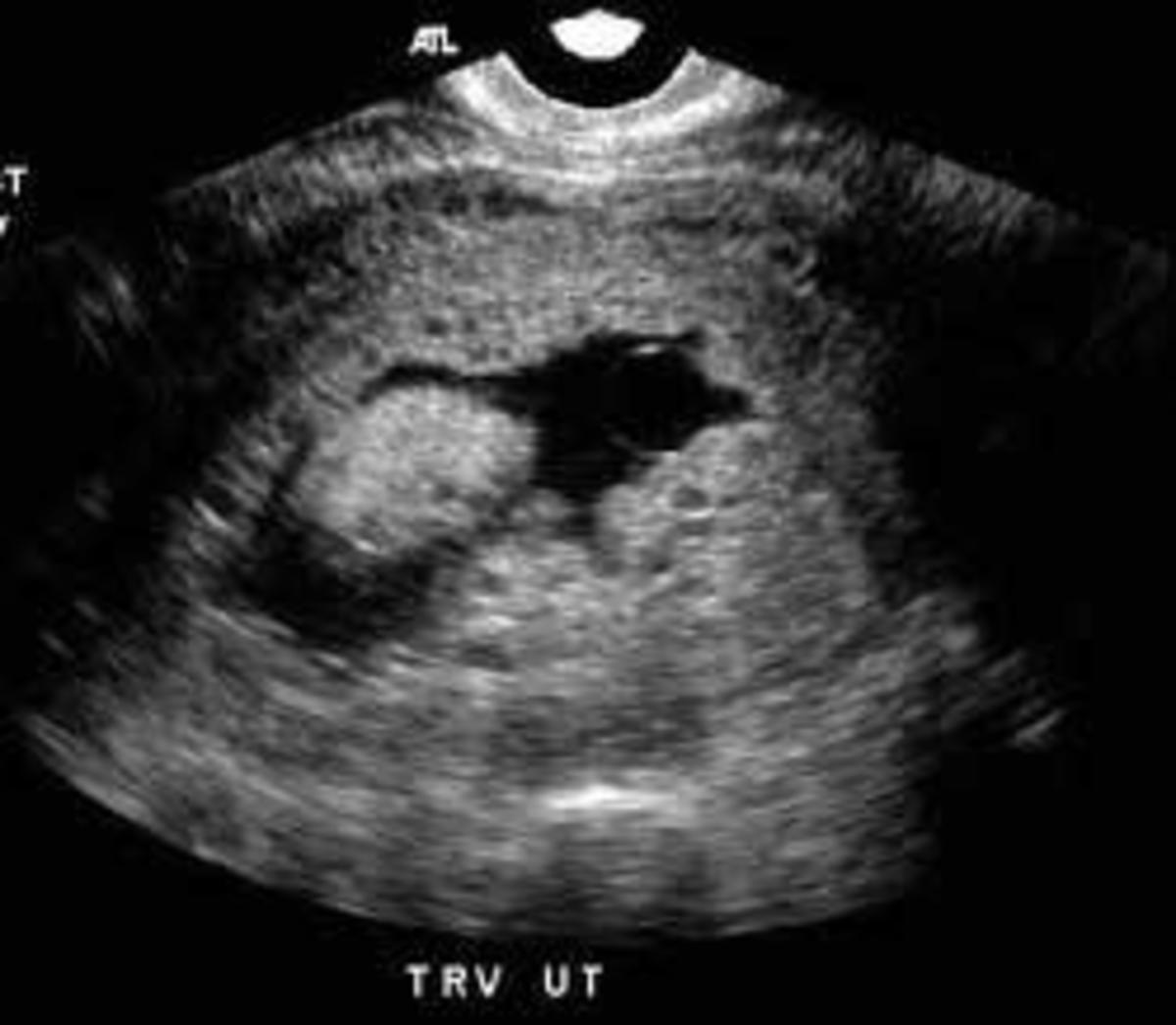 Molar Pregnancy, Complete or Partial hubpages