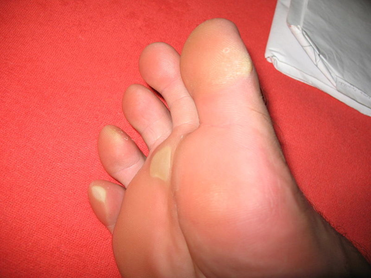 How To Remove Corns or Calluses From Your Feet HubPages
