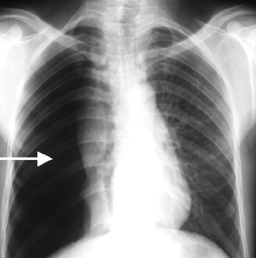 Atelectasis Vs Pneumonia Chest X Ray