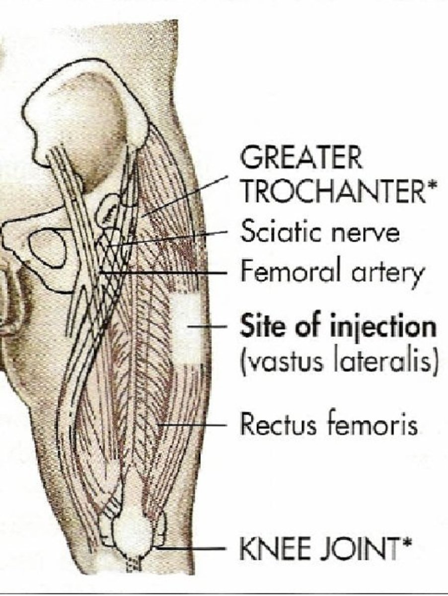 Vastus Lateralis Injection HubPages