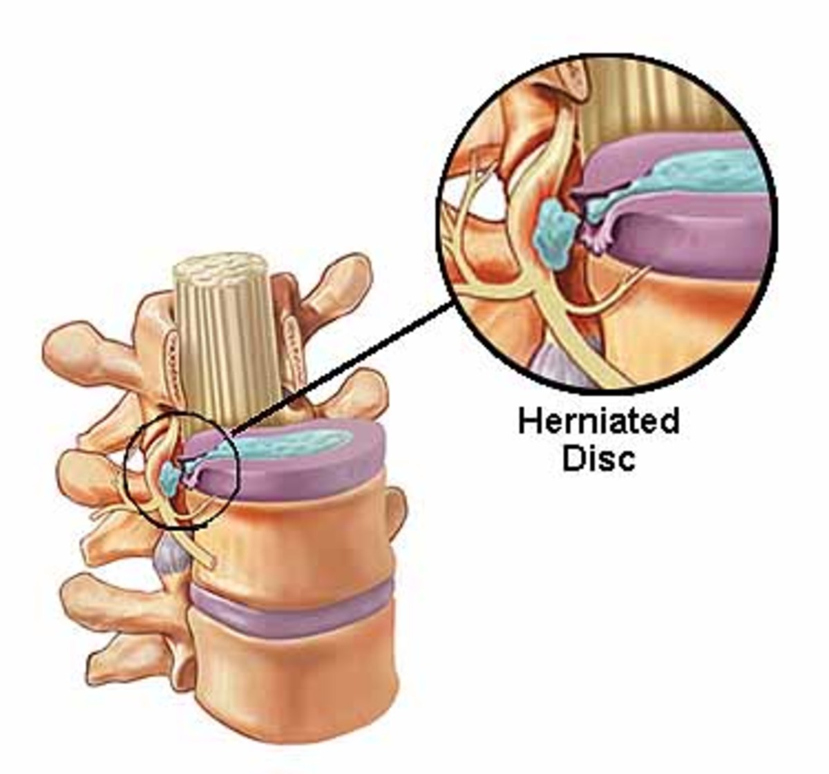 Microdiscectomy Spine Surgery for a Herniated Disc HealDove