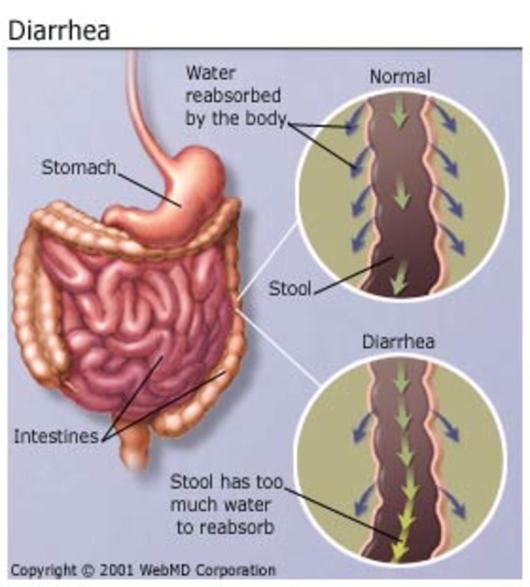 Foods to avoid while having diarrhea HubPages
