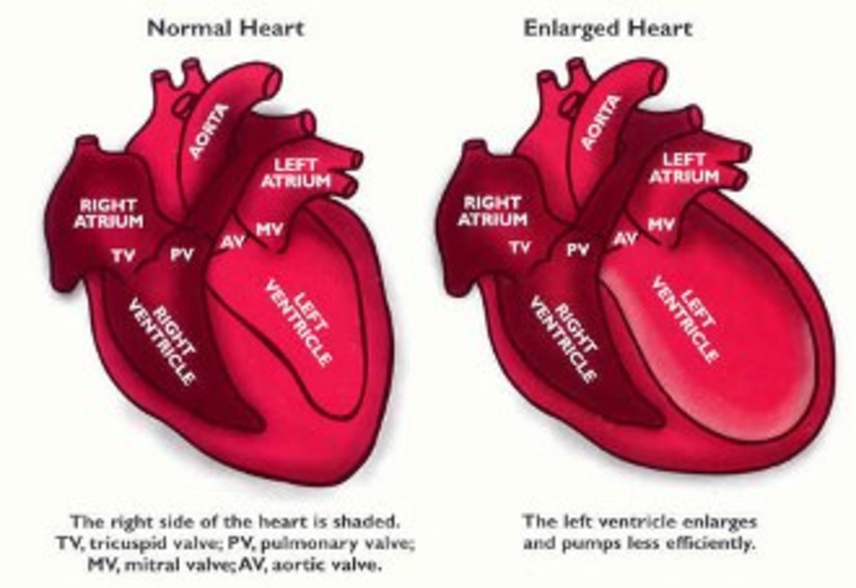Broken Heart Syndrome (Takotsubo)True Stories about Couples Dying