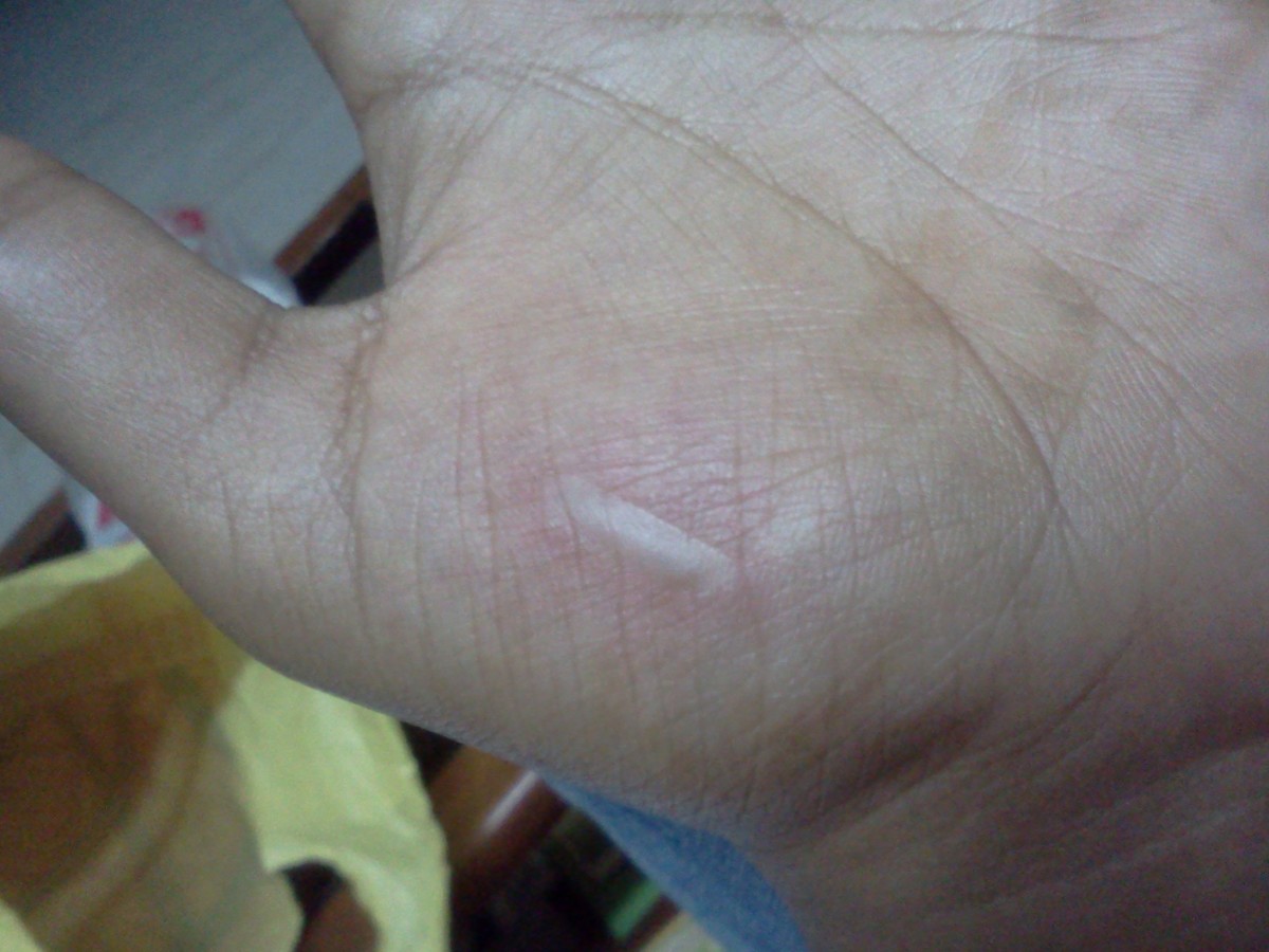 Ten Cooking Oil Burn Home Remedies and Treatments RemedyGrove