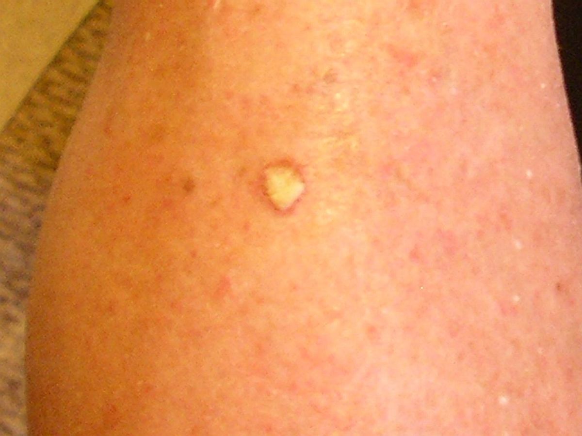 Food Grade Hydrogen Peroxide Treatment Removes Solar Keratosis HubPages