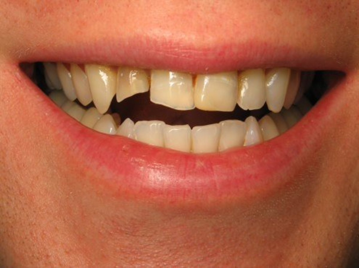 Why Did My Tooth Break… and What Happens Next? YouMeMindBody