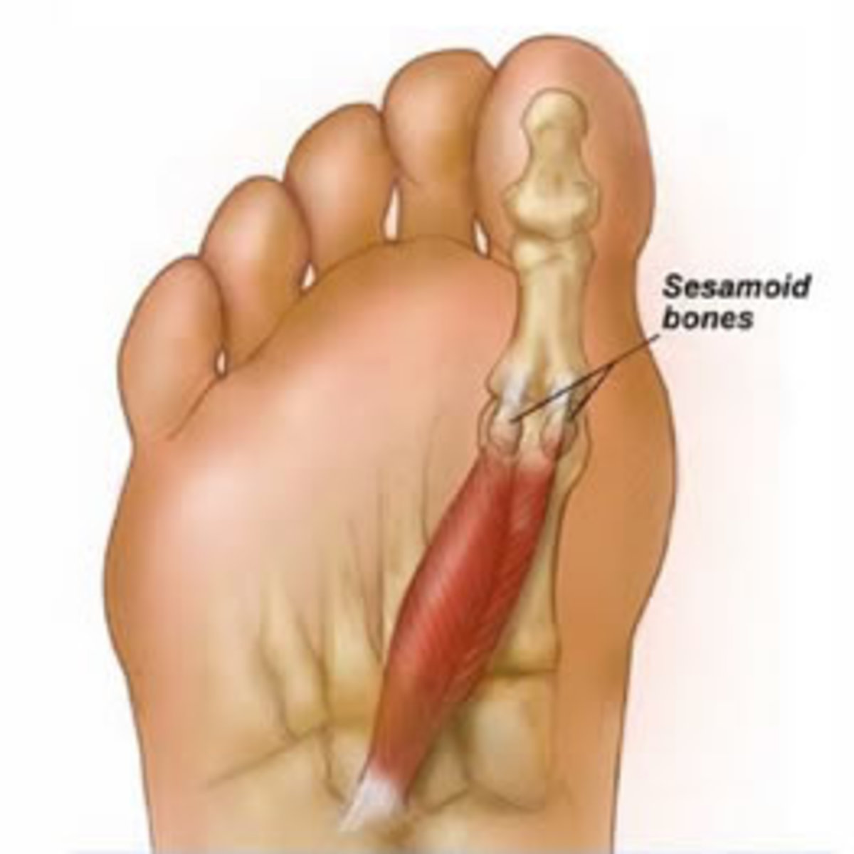 Sesamoiditis and the Sesamoid Bones HubPages