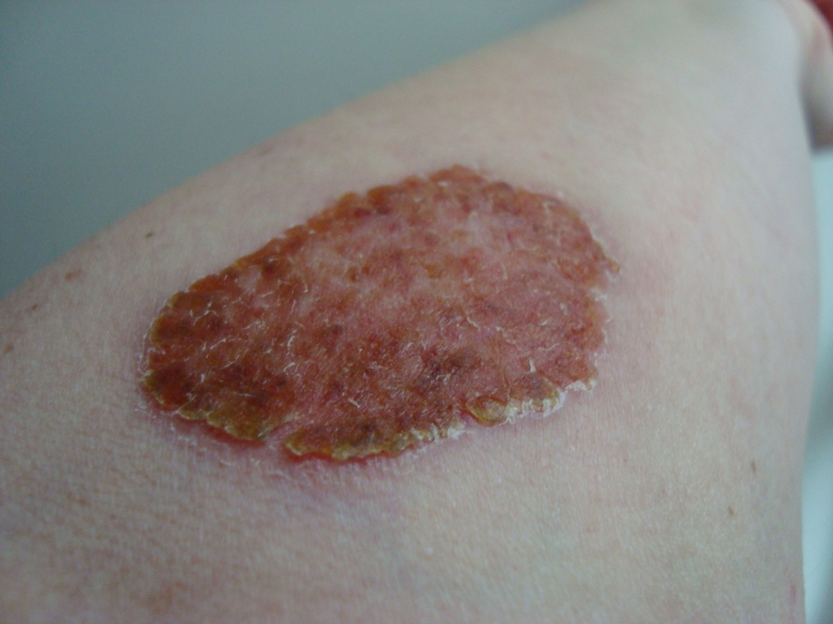 Allergic to Hair Dye Skin Test, Black Henna Tattoo, Dyed Leather Shoes