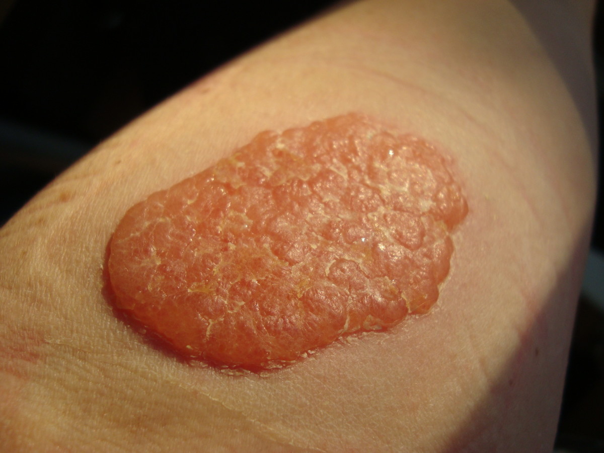 Allergic to Hair Dye Skin Test, Black Henna Tattoo, Dyed Leather Shoes